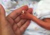 Rutshuru : un bébé né avec des malformations congénitales et …