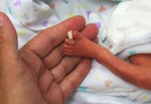 Rutshuru : un bébé né avec des malformations congénitales et …