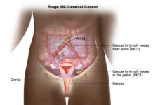 “I Discovered I Had Cervical Cancer While Pregnant”